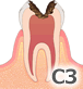むし歯C3