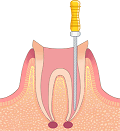 根管治療