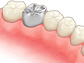 クラウン（かぶせ物）修復