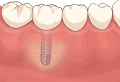 インプラント