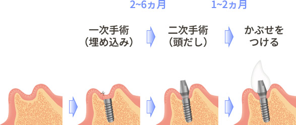 インプラントの流れ