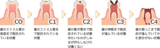 ムシ歯治療の段階図